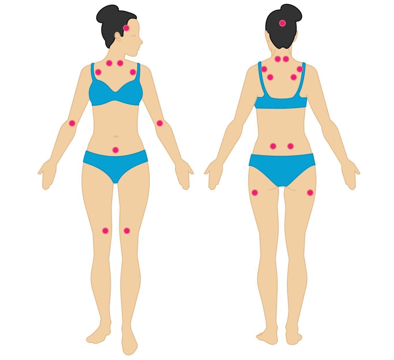Fibromialgia