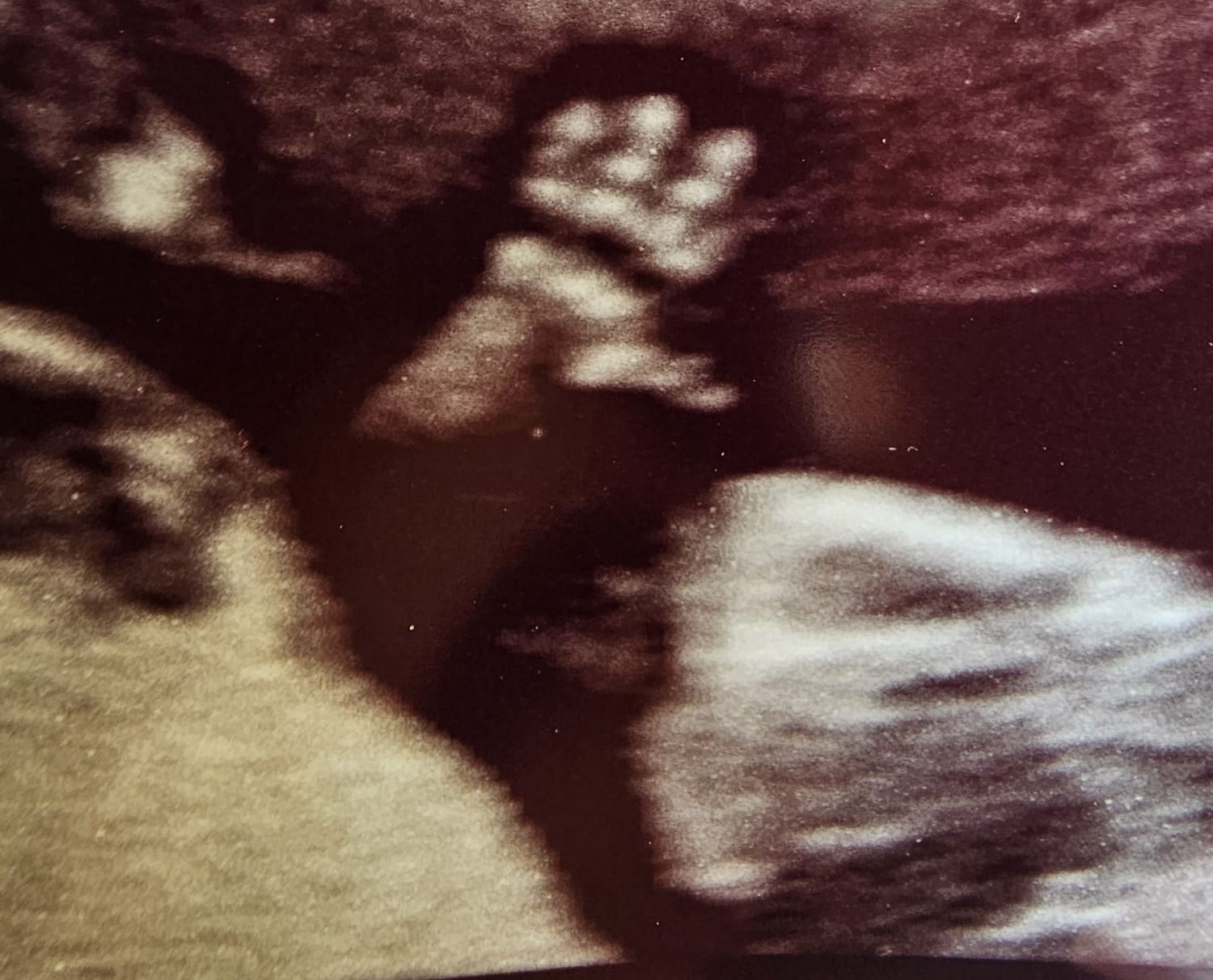 Una bambina di 13 settimane saluta il dr. Florio in ecografia!