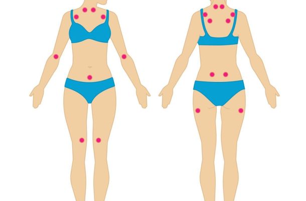 Fibromialgia