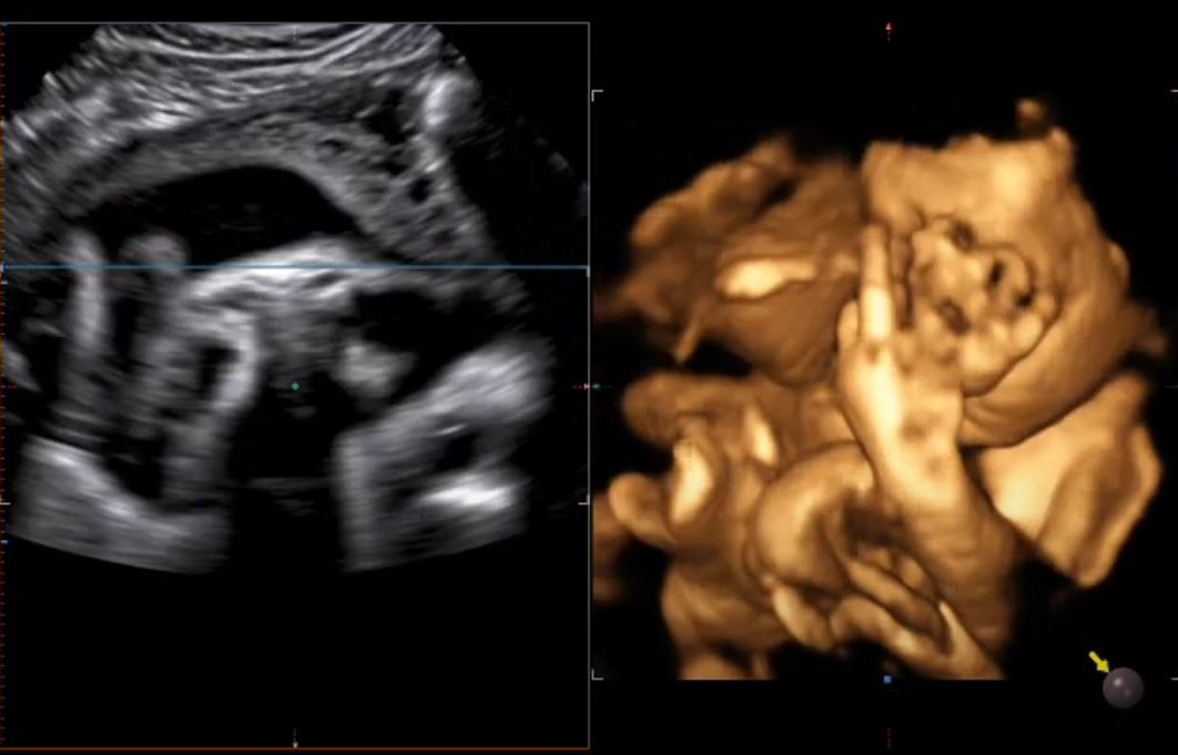 La risposta di un bimbo di 30 settimane alla pandemia e alla guerra