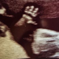 Una bambina di 13 settimane saluta il dr. Florio in ecografia!